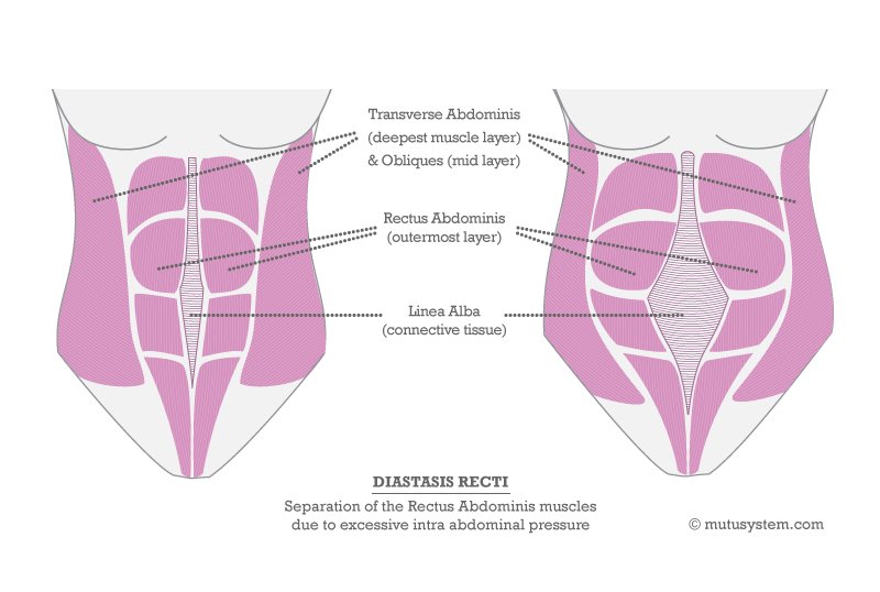 What Is Abdominal Separation Diastasis Recti Winnie Fitness What Is Abdominal Separation Diastasis Recti Winnie Fitness